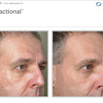 Profractional Laser Before and After