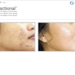 Profractional Laser Before and After
