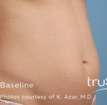 truSculpt Before and After